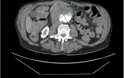 Aortoenteric fistula: Endovascular aortic aneurysm repair